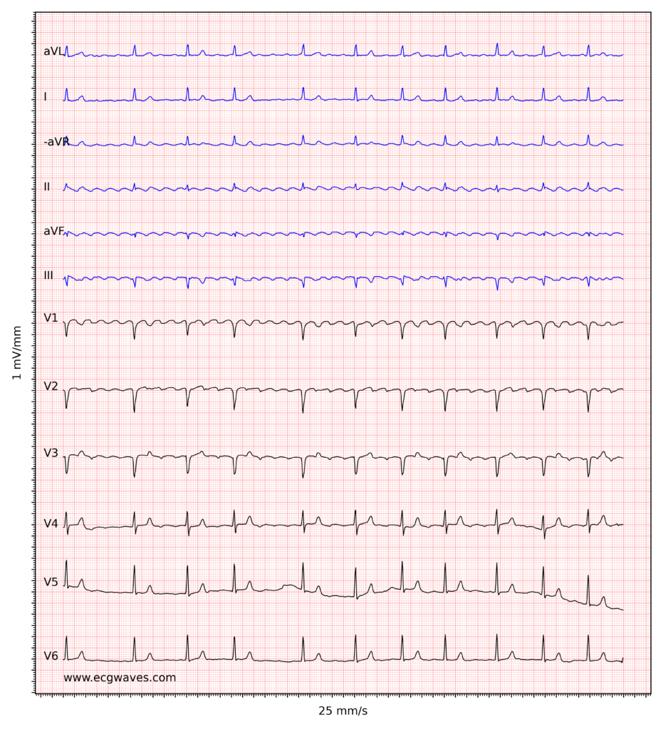 Atrial Flutter Classification Causes Ecg Diagnosis Management