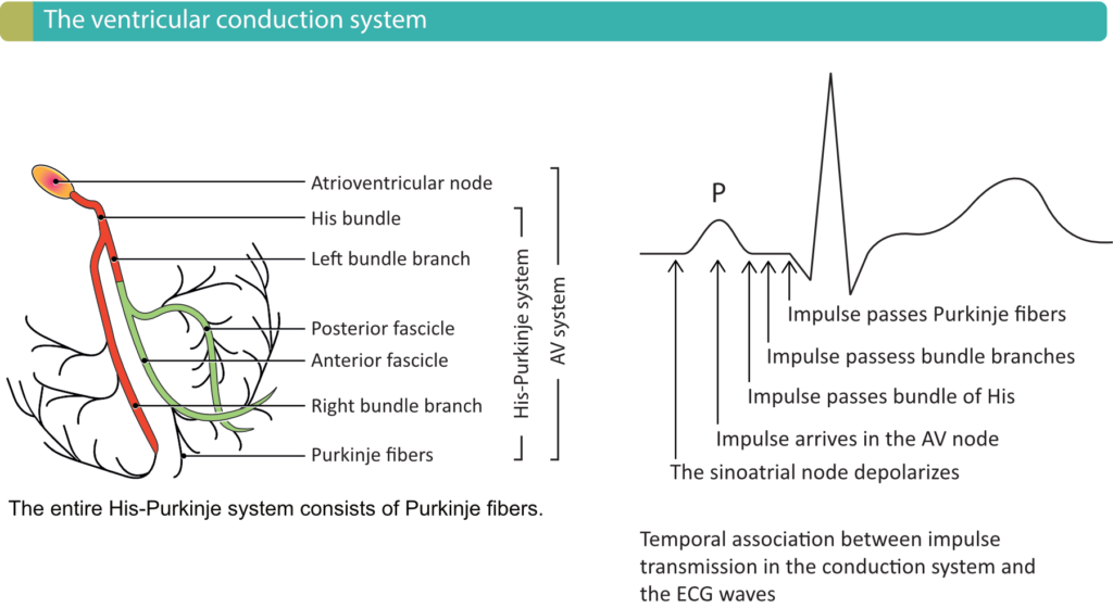Figure 1. Components of the ventricular conduction system and the temporal association between the ECG waveforms and impulse transmission through the heart. Atrioventricular (AV) blocks occur due to dysfunction in the conduction system.